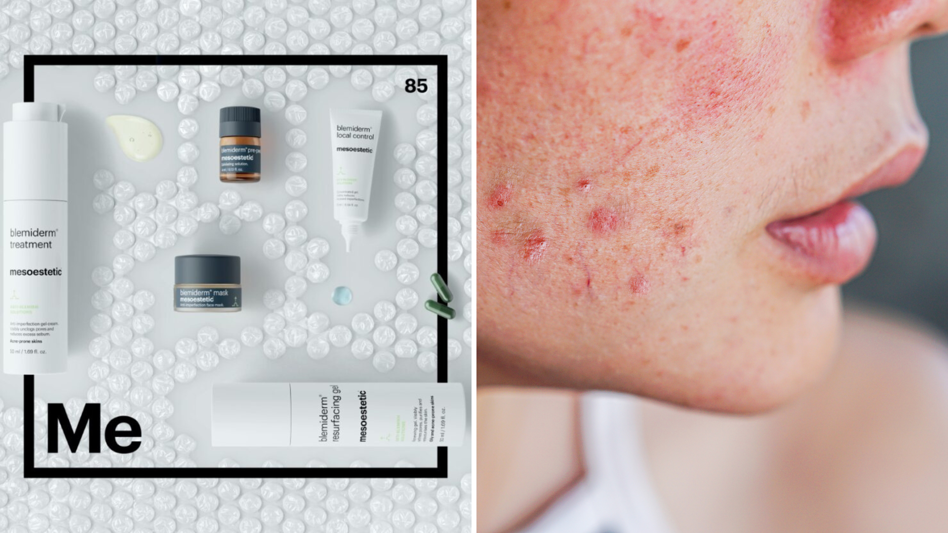 new treatment of mesoestetic to reduce acne